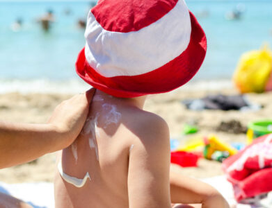 Natural Sunburn Remedies Image